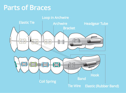 Part of Braces Diagram at Weston Orthodontics in Weston MA
